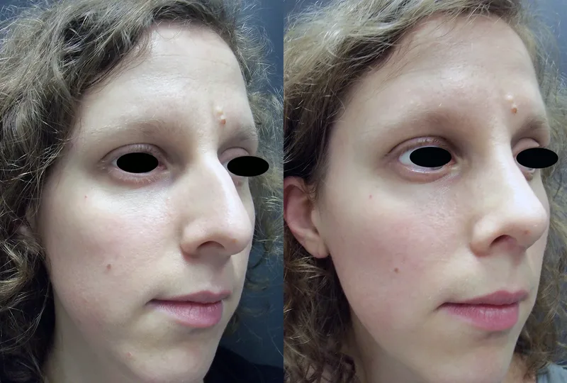 imagen rinoplastia foto antes después