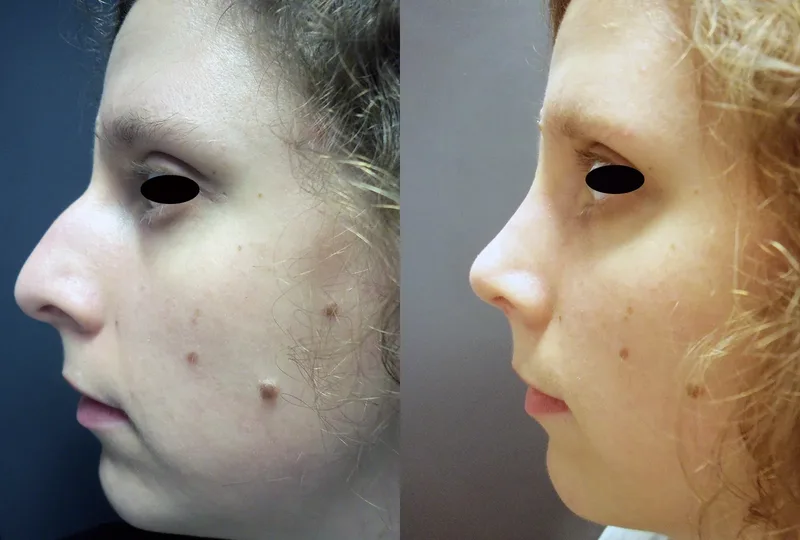 imagen rinoplastia foto antes después