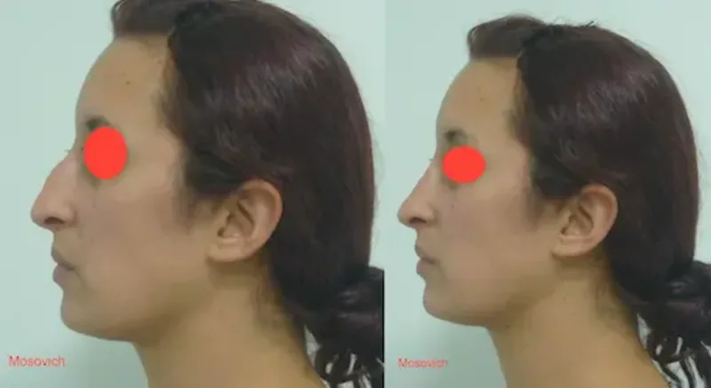 rinoplastia caso 1 perfil izquierdo antes después