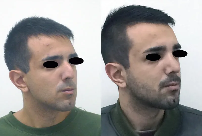 rinoplastia caso 2 oblicuo derecho antes después