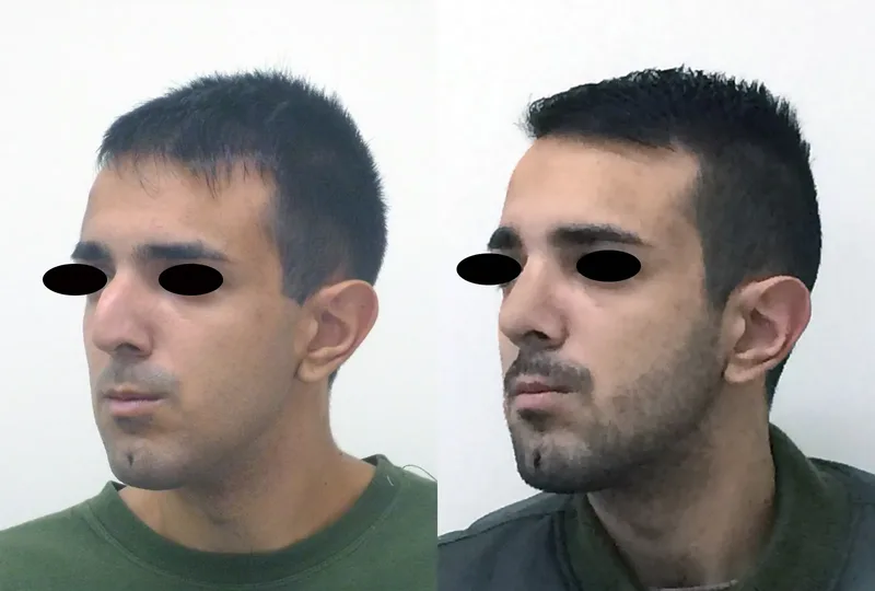 rinoplastia caso 2 oblicuo izquierdo antes después