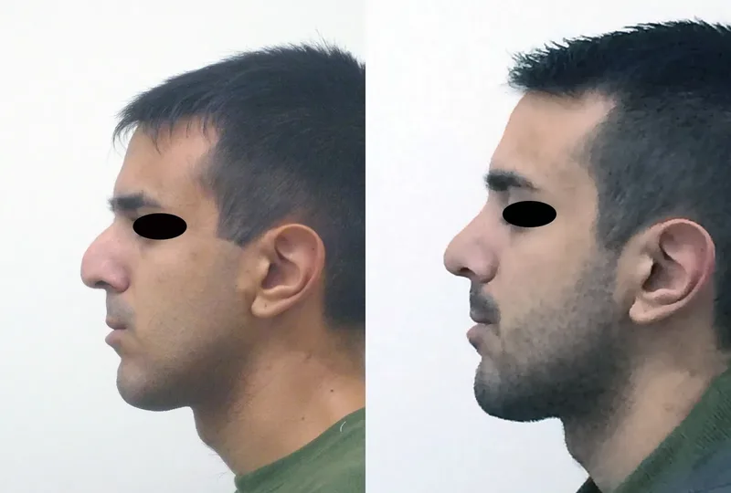 rinoplastia caso 2 perfil izquierdo antes después