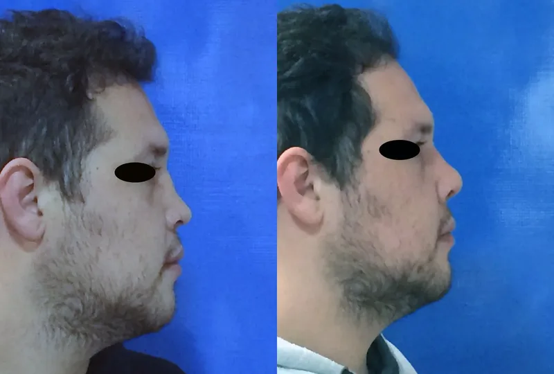 imagen rinoplastia foto antes después oblic aso 1