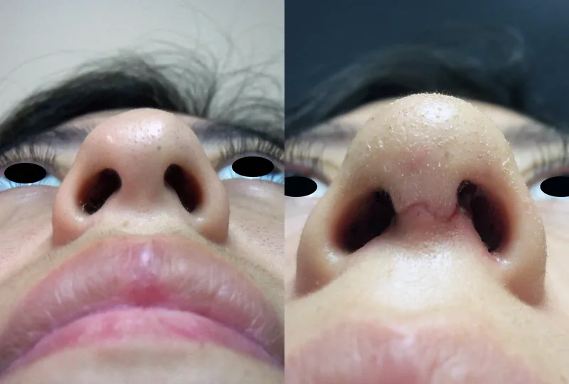 imagen rinoplastia foto antes después