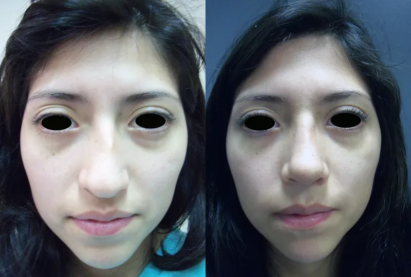 imagen rinoplastia foto antes después