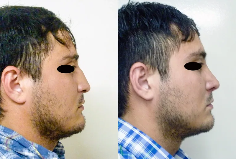 imagen rinoplastia foto antes después