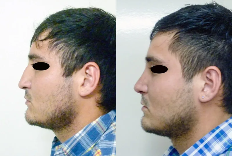 imagen rinoplastia foto antes después