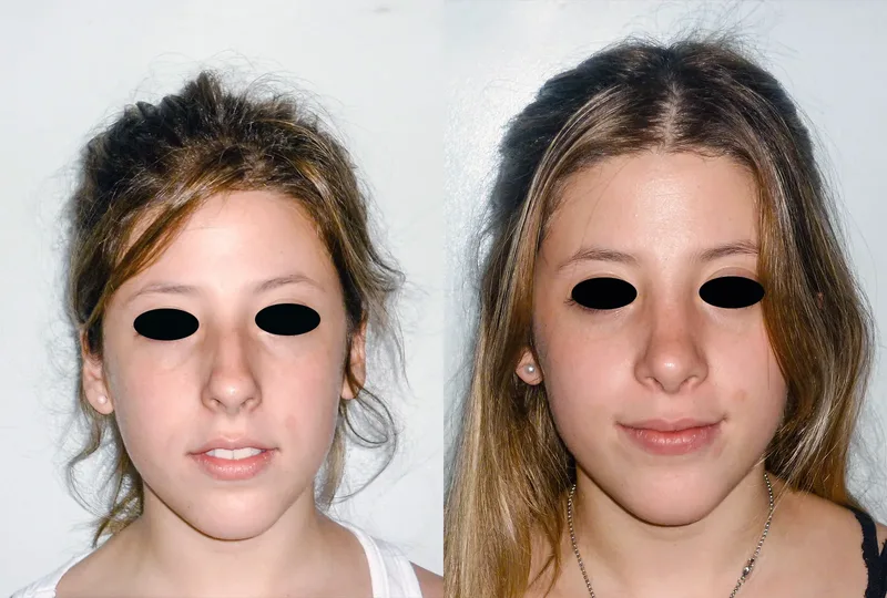 imagen rinoplastia foto antes después