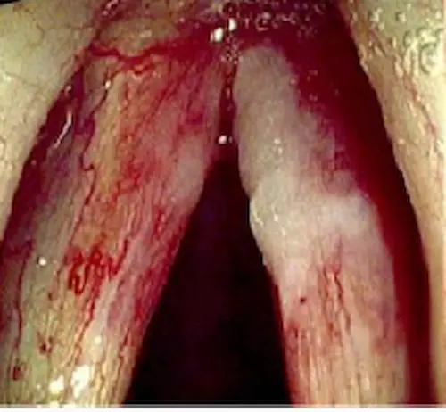 Laringe afectada por candidiasis - infección fúngica de las cuerdas vocales