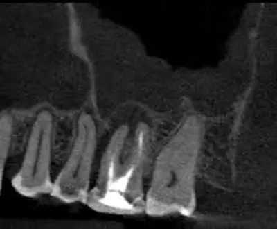 imagen radiografica de sinusitis de origen dentario.