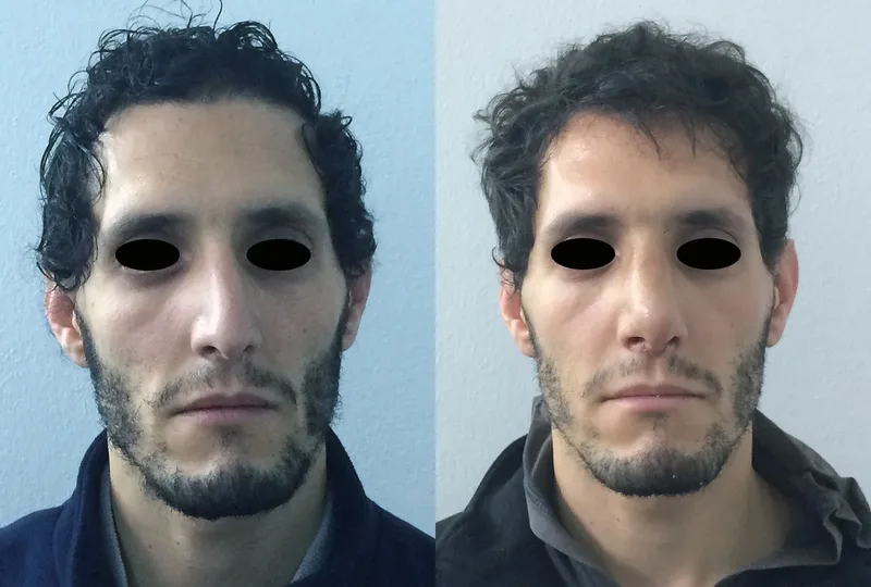 imagen rinoplastia foto antes después
