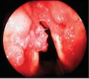 imágen de hpv en laringe