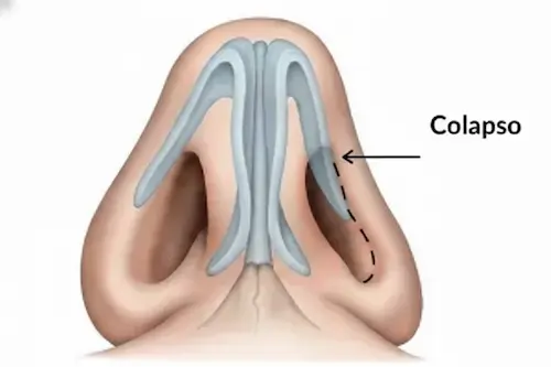 Ilustración de la anatomía nasal y flujo de aire