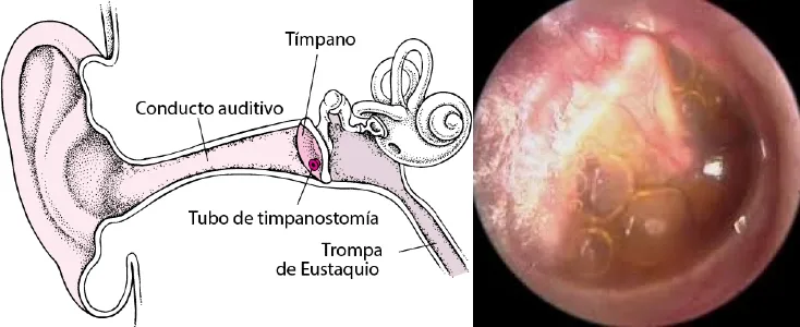 imagen de la trompa de Eustaquio