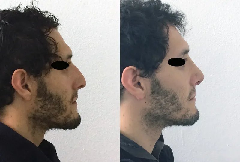 imagen rinoplastia foto antes después