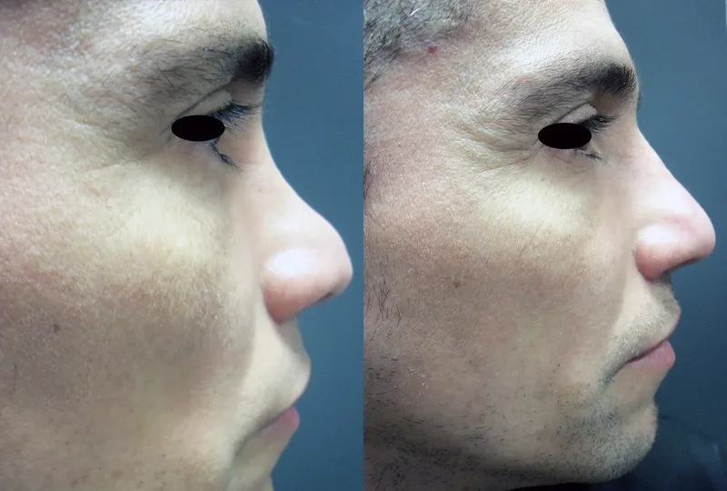 imagen rinoplastia foto antes después