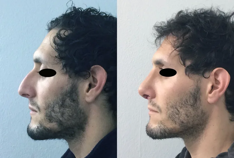 imagen rinoplastia foto antes después
