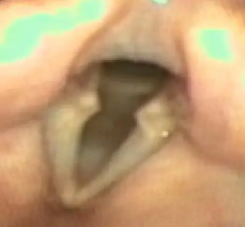 Presbilaringe con hiatus longitudinal y aritenoides promienentes.