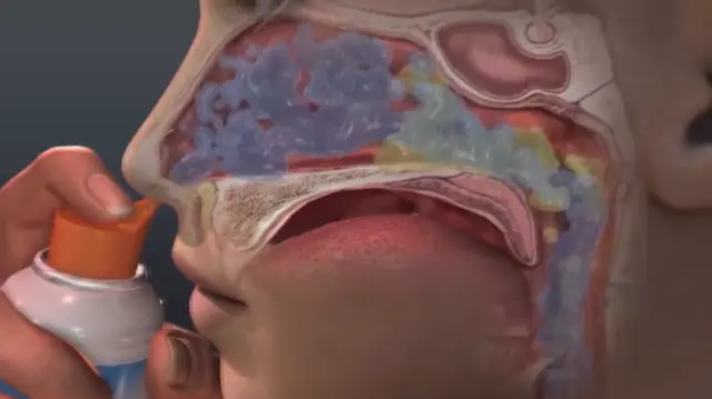 lavados nasales con solucion salina